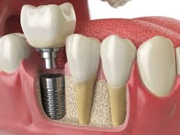 Dentist examining a patient's teeth to plan a dental implant