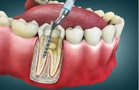 Dental surgeon examining a patient's teeth with dental tools before root canal treatment
